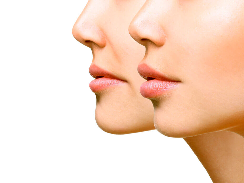 aumento de labios, pomulos y mejillas
